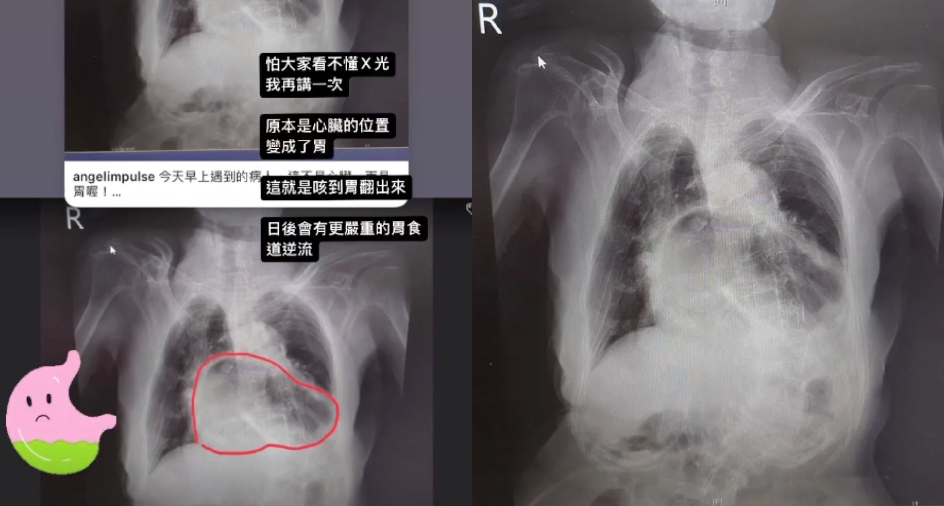 ▲▼姜冠分享一張胸部X光片，他說，這個就是經典的『咳到胃翻出來』。（圖／翻攝自姜冠宇臉書）