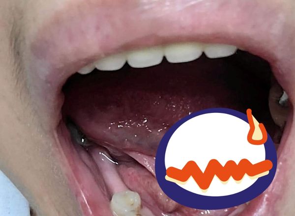 拔牙舌頭被鑽洞。（圖／翻攝自Facebook／爆料公社）