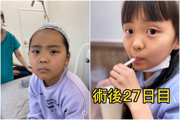 ▲日本媽媽帶9歲女兒縫雙眼皮。（圖／翻攝自YouTube／元祖整形ママ）