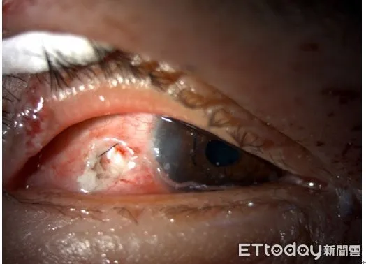 ▲驚悚！男子煮到一半卡式爐突爆炸，瓦斯罐成碎片噴入眼球。（圖／台中榮總提供）