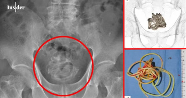 200多公分細長的繩子居然在這名男子的膀胱內緊緊纏繞著。（圖／翻攝自@InsiderNewsKe推特）
