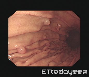 胃長20顆息肉怨「醫師沒幫切」 醫一聽放心:3情況才要動刀