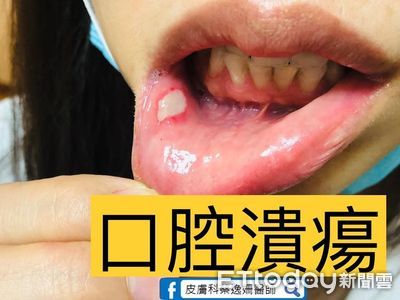 女星嘴破「點神奇藥水」秒治好!網淚推:當下痛到靠X 醫解答了