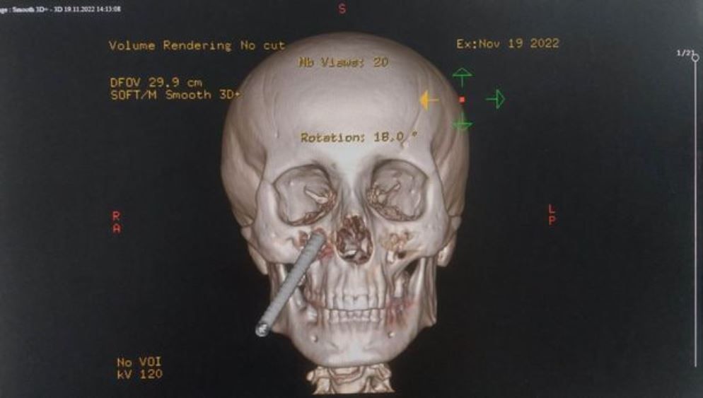 ▲▼鋼筋刺穿右臉！差數公分就「插進大腦」　建築工奇蹟生還。（圖／CEN）