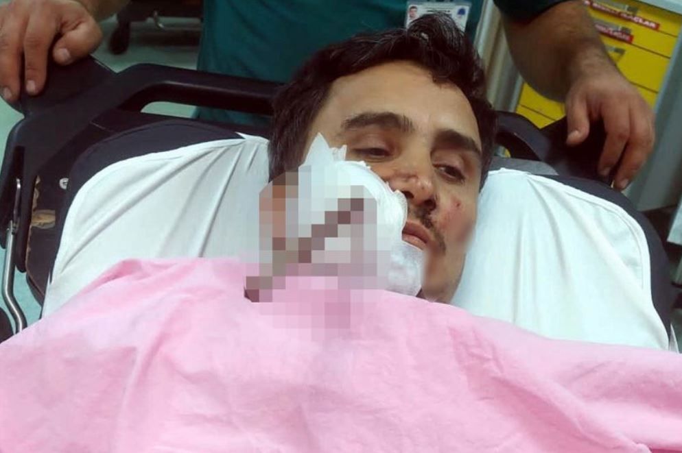 ▲▼鋼筋刺穿右臉！差數公分就「插進大腦」　建築工奇蹟生還。（圖／CEN）