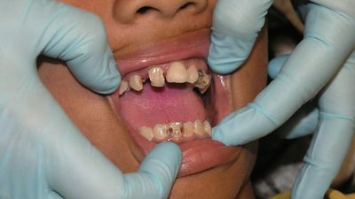 6歲童蛀牙害心臟瓣膜「被吃掉」!醫師示警:比先天心臟病更可怕