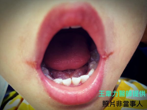 口角炎はどのように診断されますか?