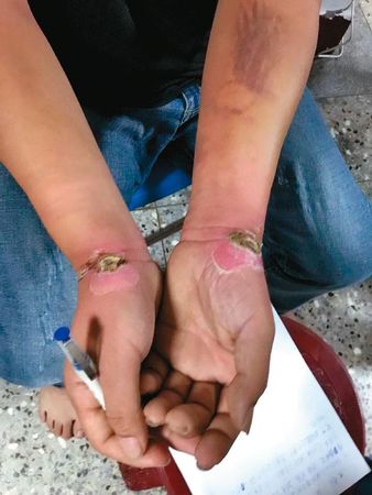 警方救出遭詐團囚禁的民眾，發現許多人的手腕被銬到潰爛。（翻攝畫面）