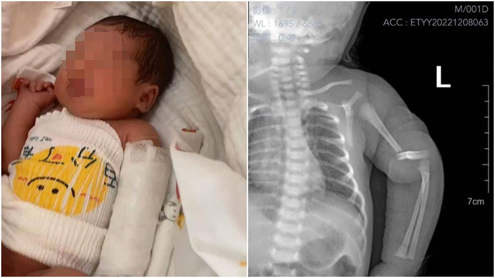 ▲安徽男嬰出世僅一天在醫院離奇手臂骨折。（圖／翻攝自微博）