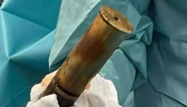 男X光檢查「直腸塞好大一根」　醫取出20cm物嚇壞：是一戰未爆彈。（圖／翻攝自Twitter）