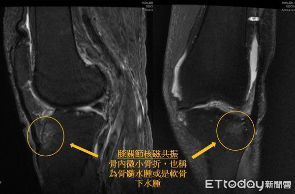 ▲▼花蓮慈濟醫院麻醉部疼痛科王柏凱主任為詹女士做骨內注射治療。(圖／慈濟醫學中心提供，下同）