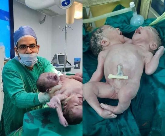 ▲▼埃及一對連體嬰經剖腹產順利出生。（圖／翻攝自viraltab.news）