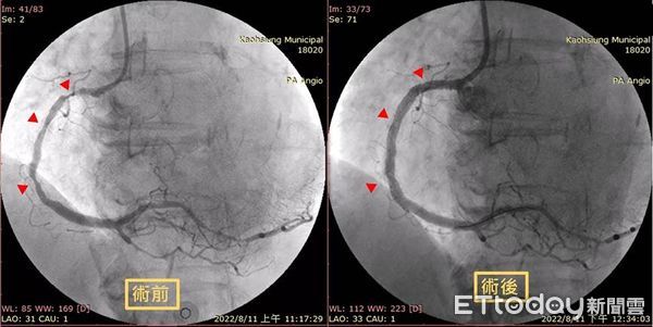 ▲醫師將阻塞的右冠狀動脈打通。（圖／記者許宥孺翻攝）