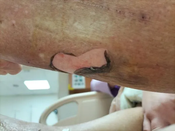 ▲使用暖暖包務必留意燒燙傷風險。（圖／翻攝自Facebook／蘇一峰）