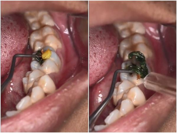 [新聞] 吃飯不要看！型男牙醫開挖「終極蛀牙」