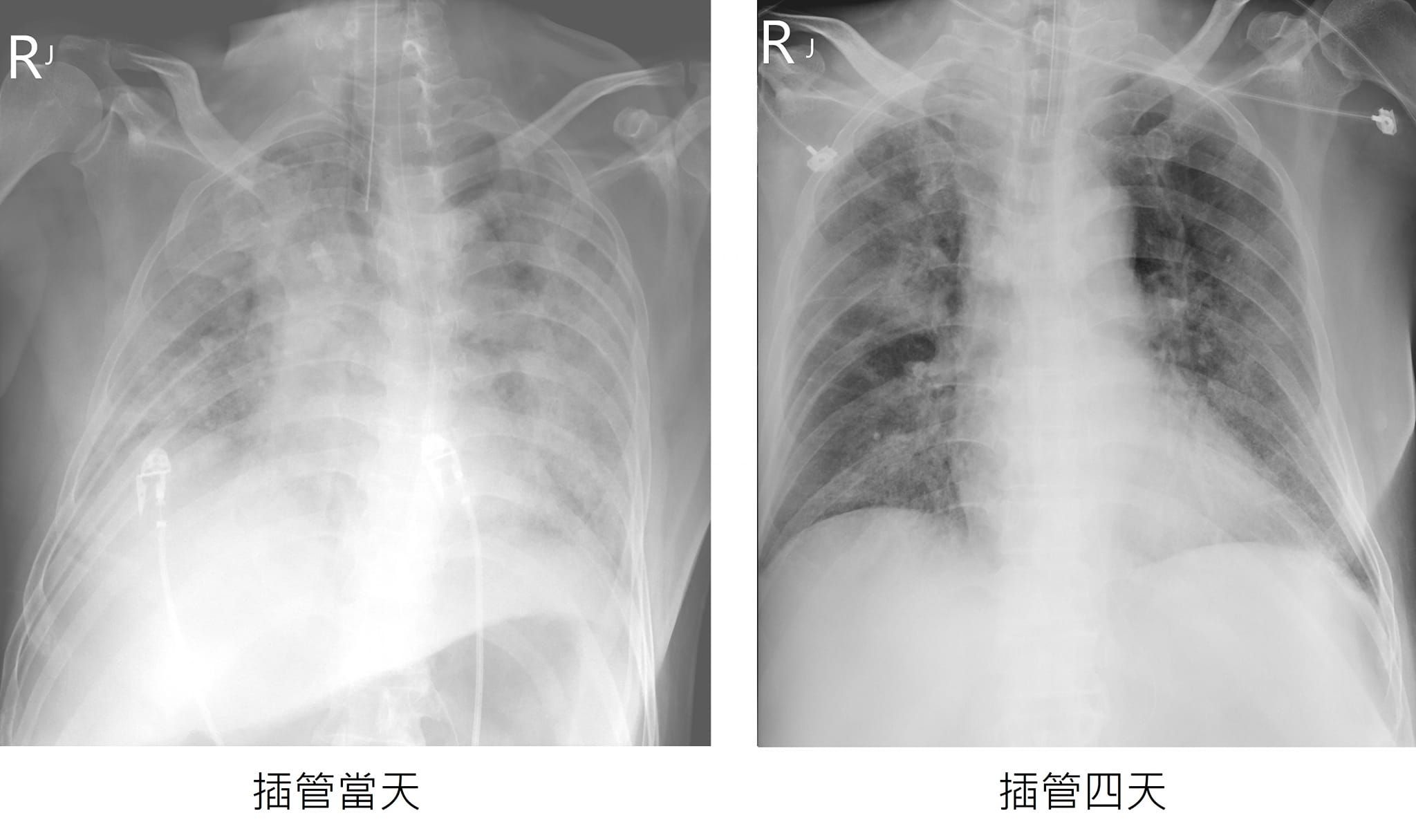 ▲「大白肺」台商最新病況！醫曝X光對比照讚：台灣醫護就是強。（圖／蘇一峰醫師授權提供）