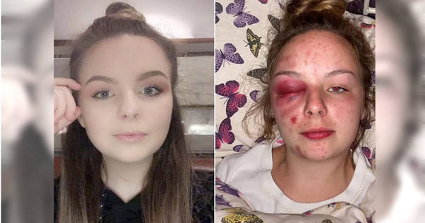 英國坎布里亞郡（Cumbria）的一名少女艾莉諾（Eleanor Williams）2019年自爆自己長期受到亞裔性侵犯集團的虐打、恐嚇、性侵、餵毒，將自己受虐照片公布。（圖／翻攝自Facebook）