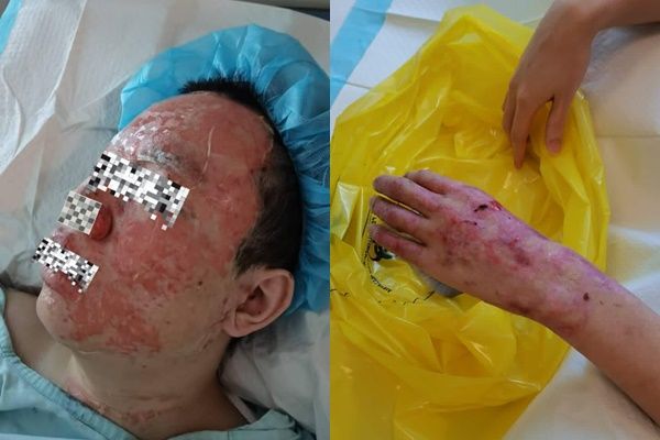 ▲▼馬來西亞一名男大生吃小火鍋時突然發生爆炸，導致他可能毀容。（圖／翻攝自Facebook）