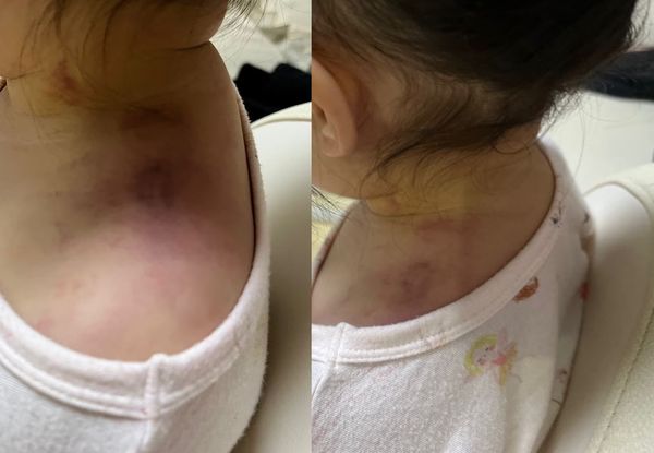 ▲▼南韓2歲女童在幼兒園遭到教師不當管教、虐待，肩膀出現嚴重瘀傷。（圖／翻攝自Nate Pann）