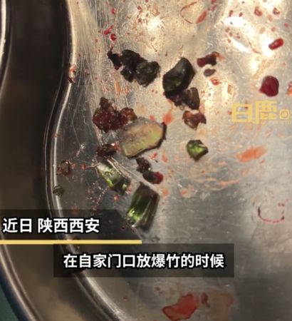 ▲▼男童在酒瓶裡點爆竹　慘遭「30多塊玻璃渣」插入體內。（圖／翻攝微博）