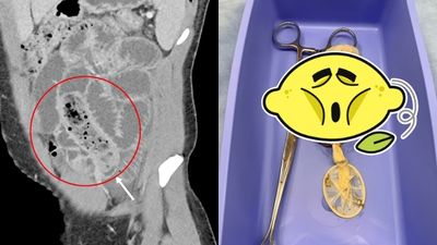 把香蕉塞進保險套「吞下肚」！男腹痛忍24小時才就醫　自稱賀爾蒙飆高失去理智