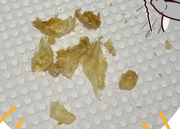 台灣|8歲妹聽不到呼叫聲！醫狂吸2分鐘…見「7坨超巨噁屎」驚呆了 | ETtoday健康雲 | ETtoday新聞雲