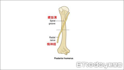 ▲圖1：左上臂後視觀的螺旋溝及橈神經之解剖位置。（圖／台中榮總埔里分院提供）