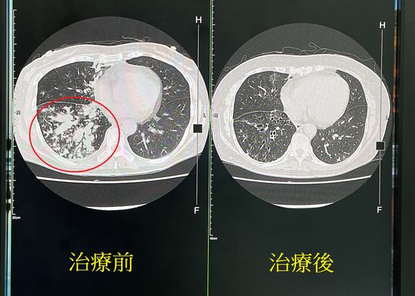 ▲▼患者因罹患支氣管擴張症，細支氣管被撐大有如一根根爆漿香腸。（圖／烏日林新醫院提供）