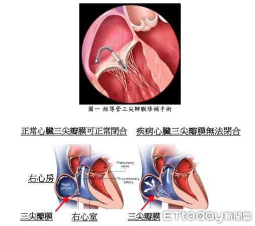 北榮「經導管三尖瓣膜修補手術」記者會。（圖／記者趙于婷攝）。