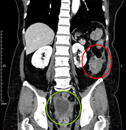 ▲▼腫瘤造成大腸套疊，紅圈處為大腸癌，綠圈處為骨盆腔腹膜黏液性腫瘤。（圖／馬偕醫院提供）