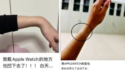 中國Apple Watch用戶控訴「手腕戴凹了」！蘋果客服傻眼　網嗆錶帶太緊亂栽贓