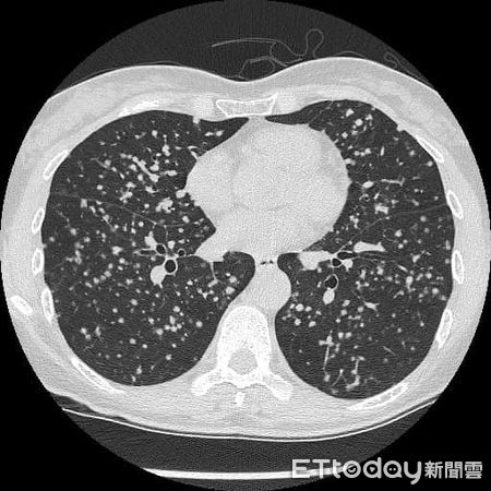 ▲▼只有輕微咳嗽！醫一掃…見她「肺整片滿天星」到處轉移：生命在倒數。（圖／蘇一峰醫師授權提供）