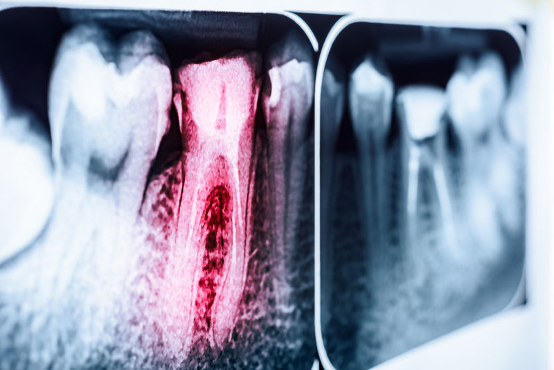 瑞士研究：「一口爛牙」也可能導致心臟病！原因曝光 | ETtoday探索