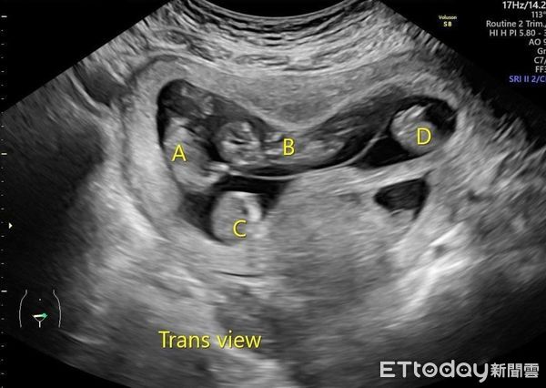 一名女性做試管嬰兒，一個胚胎發育為「罕見的同卵四胞胎」。（圖／長庚醫院提供）