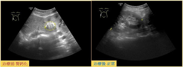 一名50歲女性沒有內科病史，非常重視養生，卻突發急性腎衰竭。（圖／中國醫藥大學新竹附設醫院提供）