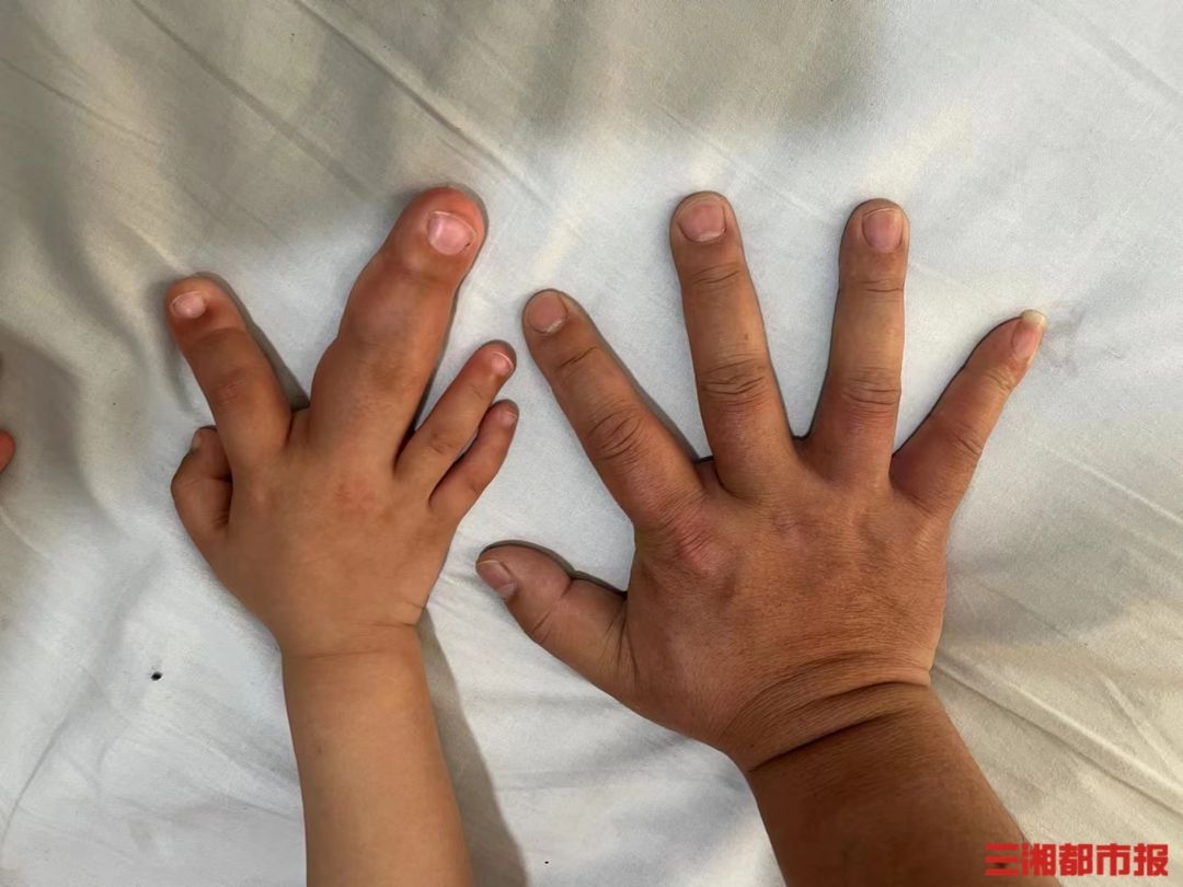 ▲2歲男童罹患罕見巨指症。（圖／翻攝自華聲在線）。
