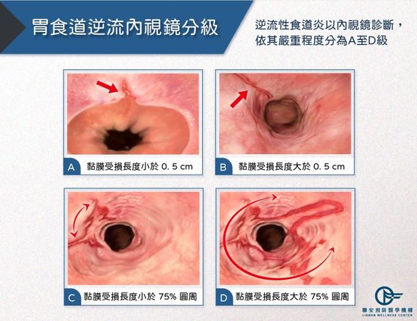 ▲▼胃食道逆流內視鏡分級。（圖／聯安診所提供）