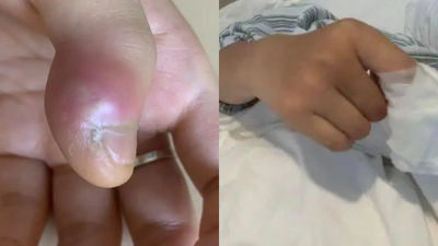 13歲少年狂咬指甲！手指腫脹引發「急性骨髓炎」險截肢　網怕：焦慮就會啃+1