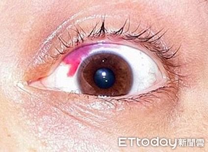 ▲▼結膜下出血。（圖／洪啟庭醫師提供）