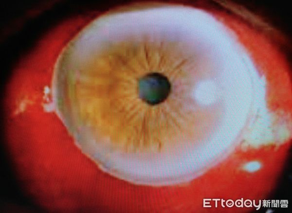 ▲▼結膜下出血。（圖／洪啟庭醫師提供）