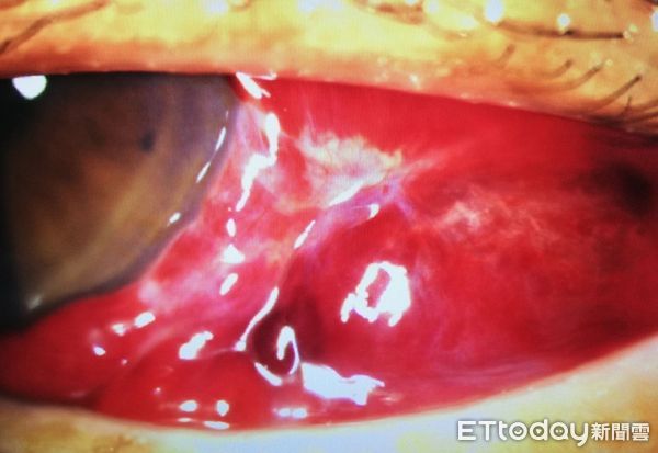 ▲▼結膜下出血。（圖／洪啟庭醫師提供）