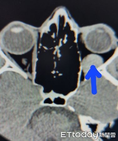 ▲▼結膜下出血。（圖／洪啟庭醫師提供）