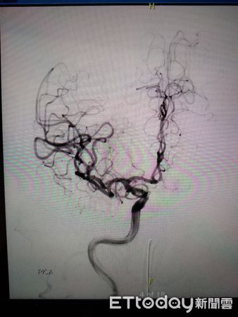 ▲新冠確診者突發腦中風，屏基團隊進行顱內動脈取栓術            。（圖／屏基提供，下同）