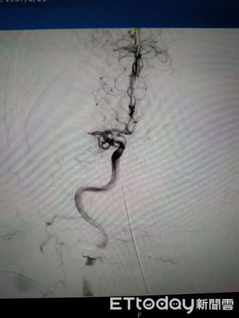▲新冠確診者突發腦中風，屏基團隊進行顱內動脈取栓術            。（圖／屏基提供，下同）