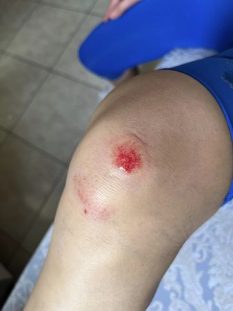 ▲丁寧的膝蓋也因摔車而擦傷。（圖／翻攝自臉書／丁寧 Ding Ning）