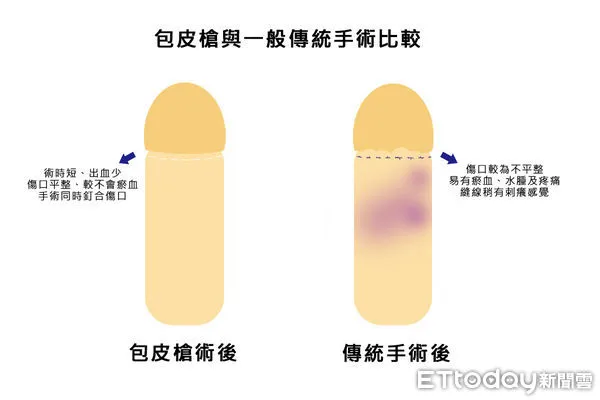 ▲林孟嚴,泌尿外科,包皮,澄清醫院。（圖／澄清醫院提供）