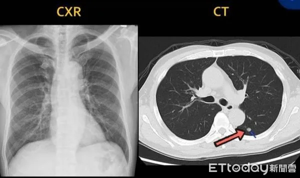 ▲X光片看不出異樣，不過用電腦斷層發現，一顆小腫瘤            。（圖／記者吳奕靖翻攝）