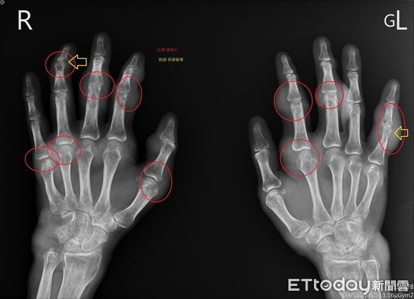 ▲痛風患者手部X光片，紅圈為痛風石，黃色箭頭為遭破壞骨頭。（圖／慈濟醫學中心提供，下同）