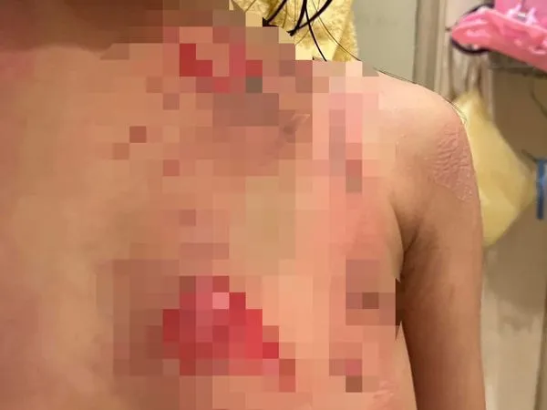 ▲▼女童遭滾燙熱水燙傷胸部，家長指控園方延誤就醫導致傷口潰爛。（圖／翻攝自臉書）