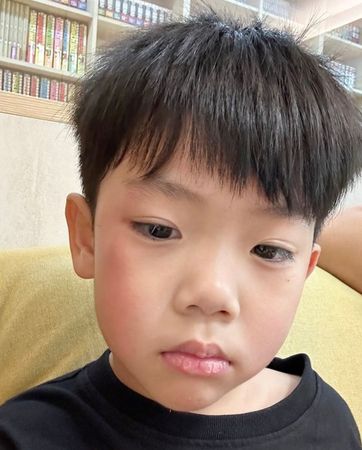 ▲4歲蔡桃貴臉頰受傷了。（圖／翻攝自IG／tsaigray2018）